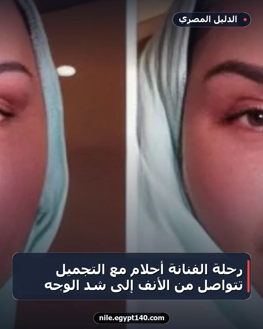 رحلة الفنانة أحلام مع التجميل تتواصل من الأنف إلى شد الوجه